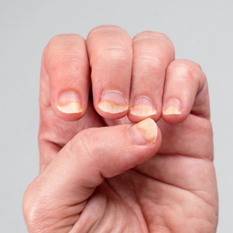 پسوریازیس ناخن 