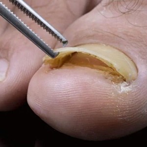 اونیکولیز ناخن 